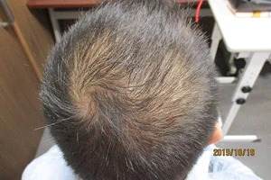 頭頂部の内服開始前