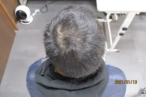 頭頂部の内服1年3か月後症例写真