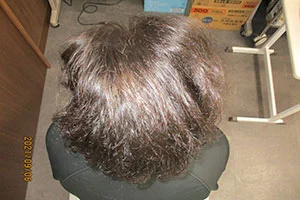 AGA治療内服1年後